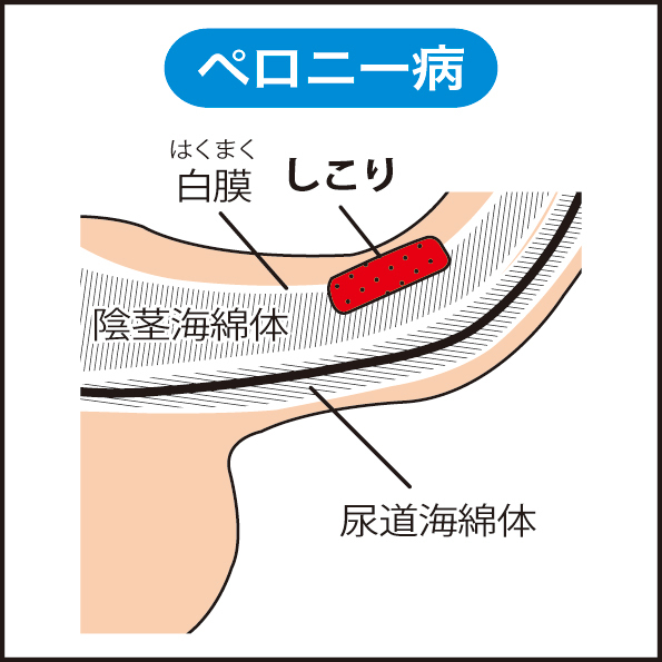 短小包茎とは！短小は何センチから？日本人の平均サイズや治療法 - アトムクリニック -