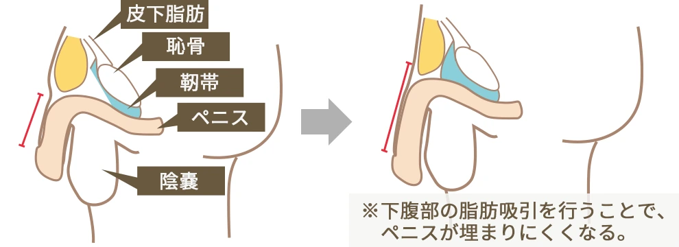 女性が思う理想のペニスサイズ – メンズ形成外科 | 青山セレス&船橋中央クリニック