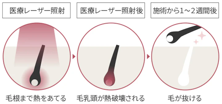 抜毛症は治療すべき？治療方法や症状を抑えるコツについて解説 | AGA・抜け毛・薄毛治療のAGAメディカルケアクリニック【公式】