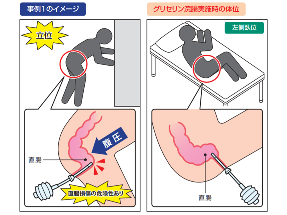 tips]アナル奴隷の作り方。浣腸排泄でM女を調教しよう | 私雨 アナル奴隷系SM調教ブログ