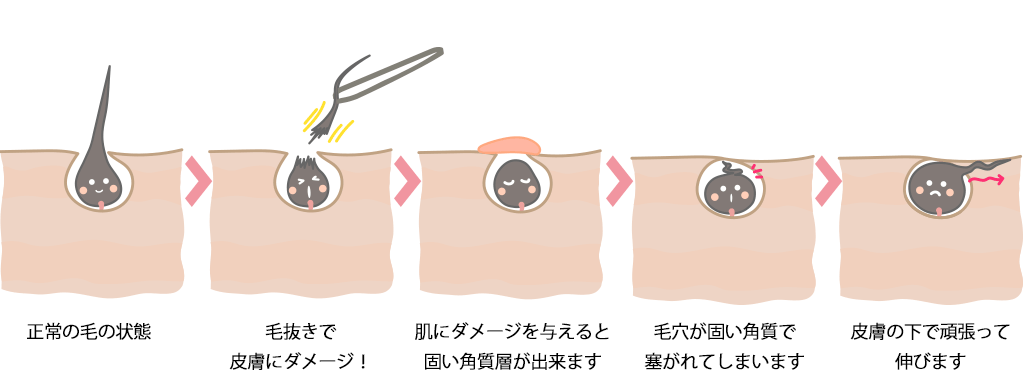 ヒゲを抜き続けると肌がボロボロに！確実にヒゲの悩みを解決する方法 | メンズ脱毛百科事典 リンクスペディア