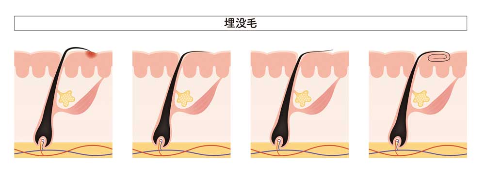 脱毛のプロが語る ここだ毛の裏話 第４回