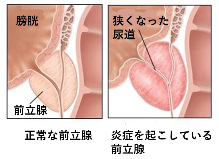 尿道オナニー】尿道に細い棒を挿れて直接、前立腺を刺激する！？【王道/尿道責め】 - YouTube