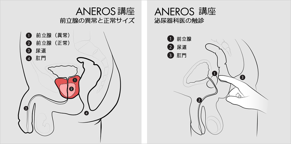 前立腺がん手術後の尿漏れ